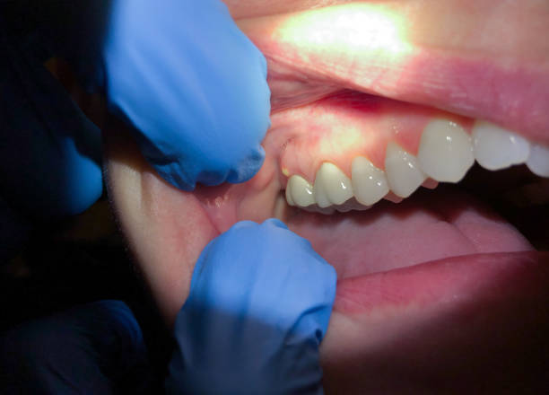 Best Emergency Root Canal Treatment in Olathe, KS